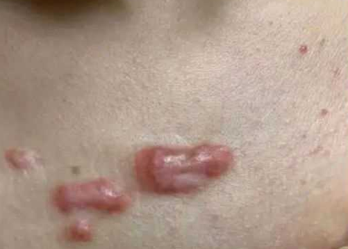 ����С���̺۸�����������<a href='/' target='_blank' title='�ൺƤ����ҽԺ'><span style='color: #0000ff'><strong>�ൺƤ����ҽԺ</strong></span></a>��