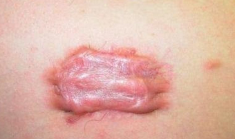 <a href='/' target='_blank' title='青岛皮肤病医院'><span style='color: #0000ff'><strong>青岛皮肤病医院</strong></span></a>——瘢痕性瘙痒的5个特点,疤痕瘙痒的危害