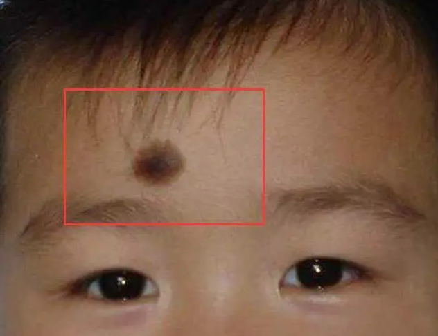 黑色胎记有哪些治疗方法?如何治疗黑发胎记?青岛皮肤病医院