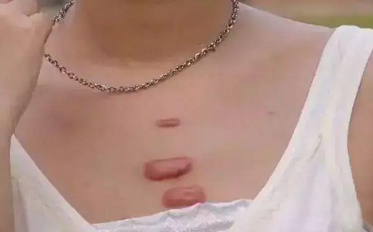 �ൺ�ļ�ҽԺ����̺ۺã���α����˿��أ�<a href='/' target='_blank' title='�ൺƤ����ҽԺ'><span style='color: #0000ff'><strong>�ൺƤ����ҽԺ</strong></span></a>