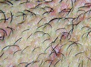 ¡¾<a href='/' target='_blank' title='ÇൺƤ·ô²¡Ò½Ôº'><span style='color: #0000ff'><strong>ÇൺƤ·ô²¡Ò½Ôº</strong></span></a>¡¿Á³ÉϳöÏÖëÄÒÑ×Ö¢×´Ôõô°ì£¿