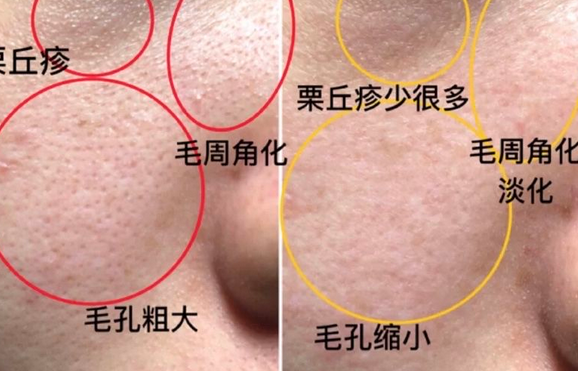 <a href='/' target='_blank' title='青岛皮肤病医院'><span style='color: #0000ff'><strong>青岛皮肤病医院</strong></span></a>分享——激光治疗毛周角化病相关问题