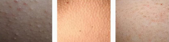 <a href='/' target='_blank' title='青岛皮肤病医院'><span style='color: #0000ff'><strong>青岛皮肤病医院</strong></span></a>治疗方式——毛周角化的病可以怎么治疗?