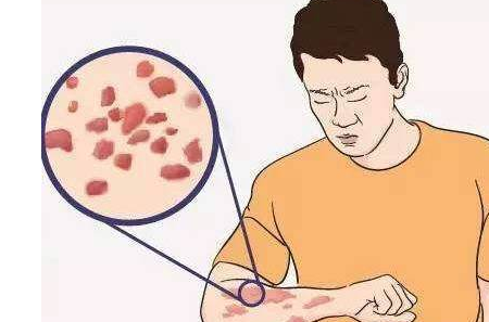 <a href='/' target='_blank' title='�ൺƤ����ҽԺ'><span style='color: #0000ff'><strong>�ൺƤ����ҽԺ</strong></span></a>ҽ����ϸ���ܣ�ʪ������Է�Ϊ7��ע������