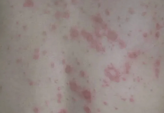 ��<a href='/' target='_blank' title='�ൺƤ����ҽԺ'><span style='color: #0000ff'><strong>�ൺƤ����ҽԺ</strong></span></a>��������Ƥ�׻�������֢״��