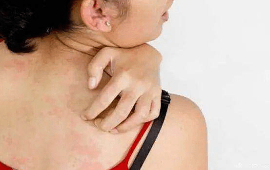 青岛专科皮肤病医院排名前十,青岛哪家医院治疗荨麻疹好呢?