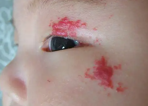 在青岛治疗鲜红胎记要多少钱?3个因素影响费用