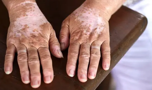 ���������֢״�Ľ��ܡ��ൺ����Ƥ����ҽԺ���а�TOP10