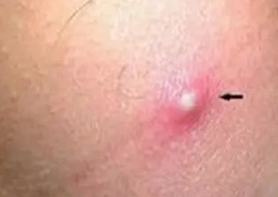 头皮毛囊炎怎么护理?青岛毛囊炎干预推荐机构排名【22年已更新】