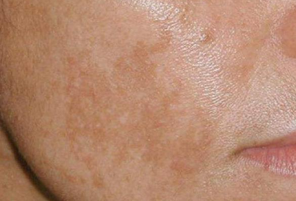 ��ʵʱ�����������������ƺְ�&mdash;&mdash;<a href='/' target='_blank' title='�ൺƤ����ҽԺ'><span style='color: #0000ff'><strong>�ൺƤ����ҽԺ</strong></span></a>����ǰ��