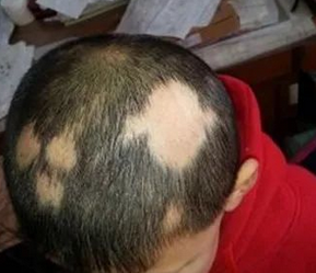 ��ͺԭ������Щ�����°�ͺ���Ĵ�����-<a href='/' target='_blank' title='�ൺƤ����ҽԺ'><span style='color: #0000ff'><strong>�ൺƤ����ҽԺ</strong></span></a>ʮ��������